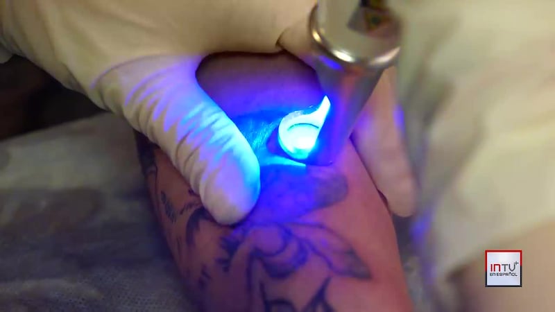 ¿Te arrepentiste? Las dificultades (y el costo) de eliminar un tatuaje