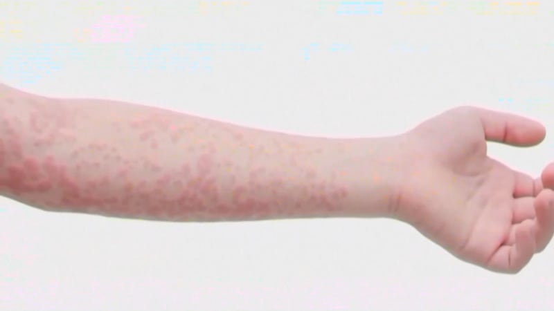 Brote de sarampión se extiende por el suroeste: 138 casos en un radio de dos horas de Las Vegas